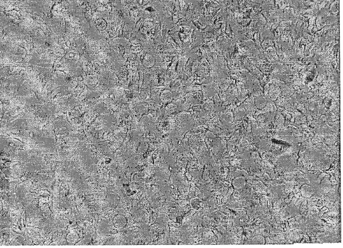 Globules rouges déformés en faucille au microscope